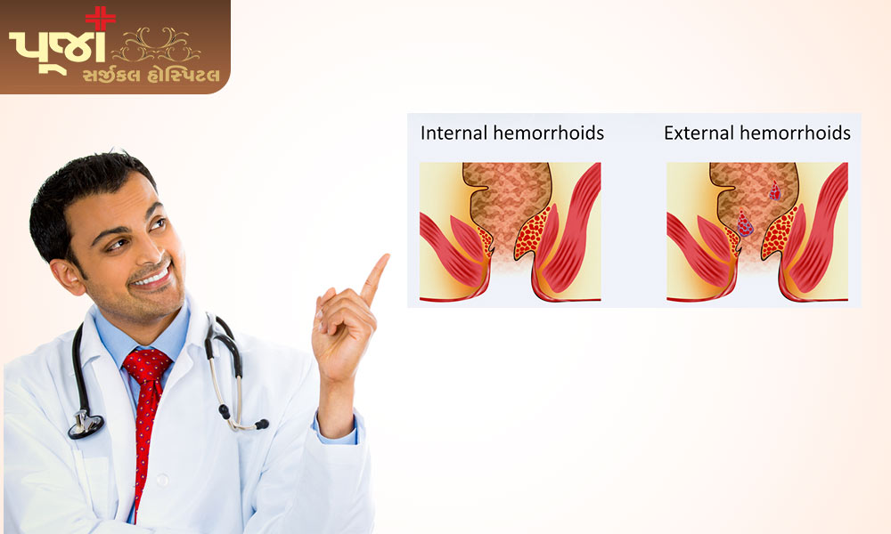 What are Haemorrhoids and their prime causes?