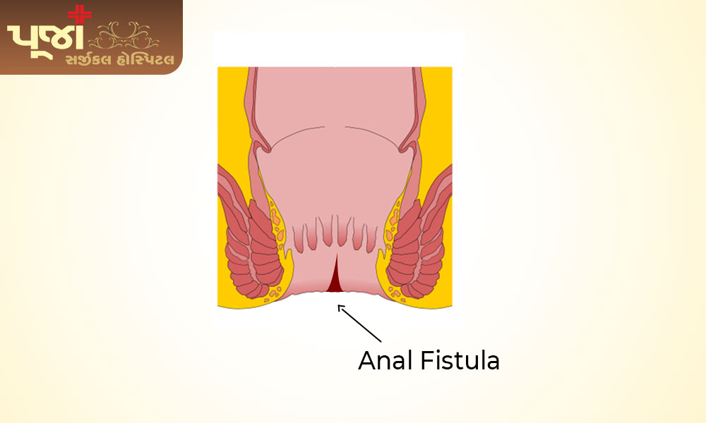 What is Anal Fistula