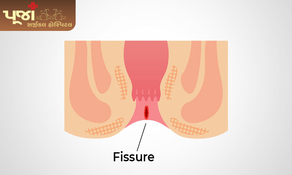 What is Fissure