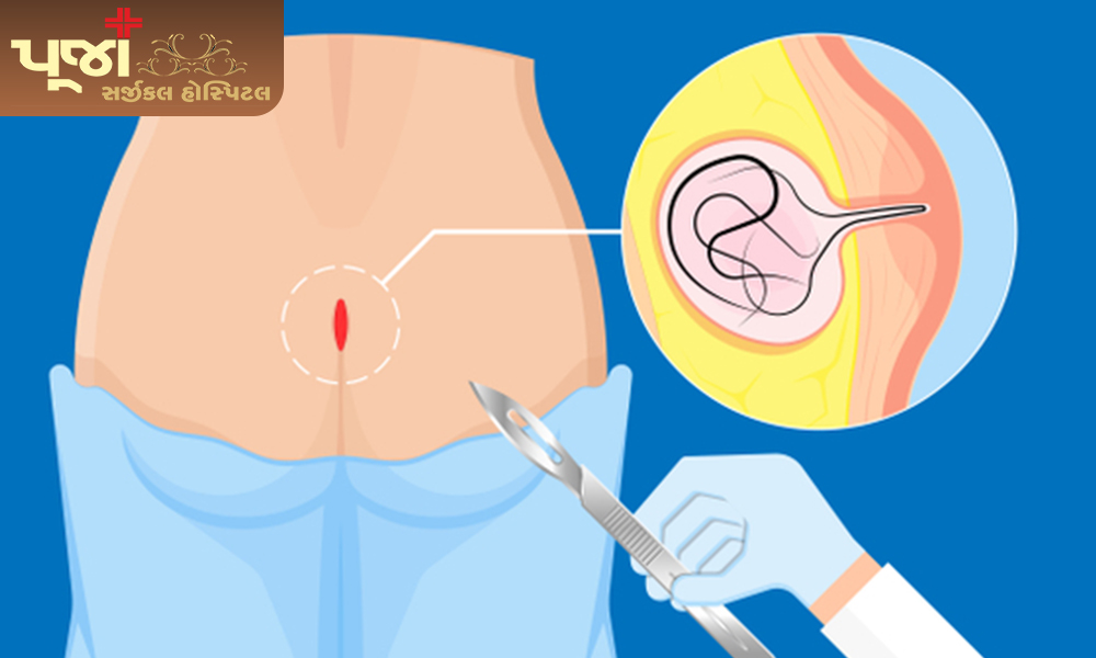What is a pilonidal sinus?