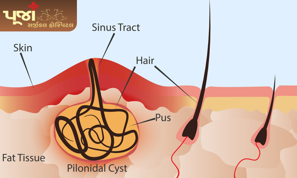 Who are prone to pilonidal sinus