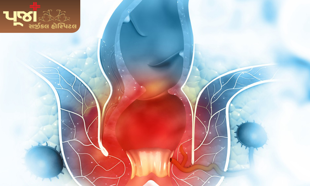 What to know about haemorrhoids