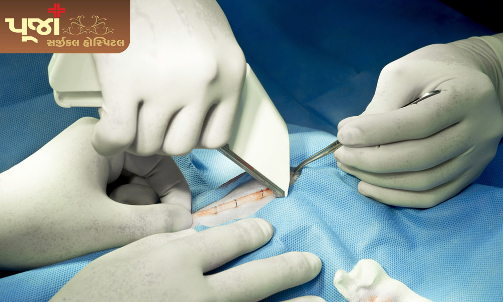 Piles stapler surgery